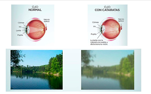 En ascenso, cataratas por diabetes y envejecimiento